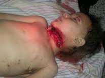 مرض البطان الرحمي يبدأ في وقت قريب من الدورة الأولى للفتاة